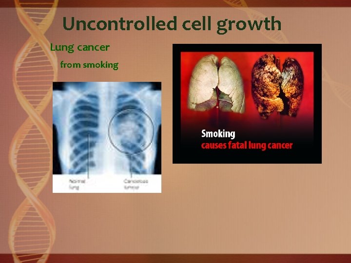 Uncontrolled cell growth Lung cancer from smoking 