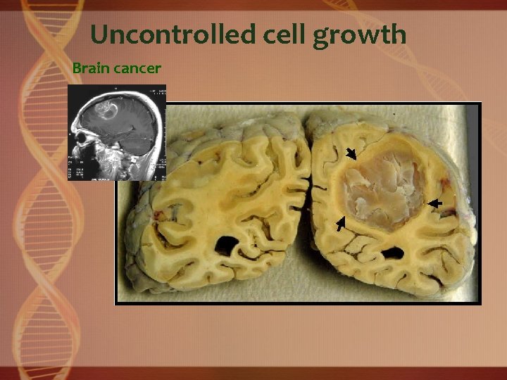 Uncontrolled cell growth Brain cancer 