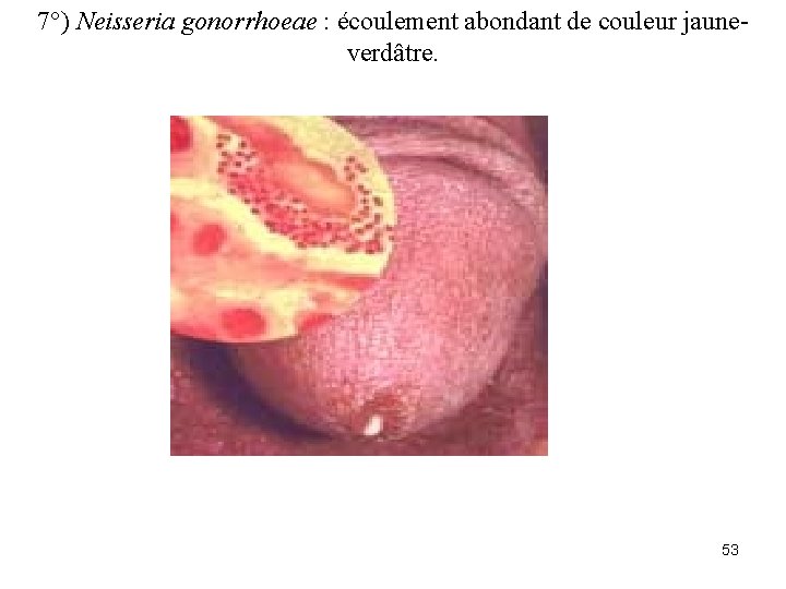7°) Neisseria gonorrhoeae : écoulement abondant de couleur jauneverdâtre. 53 