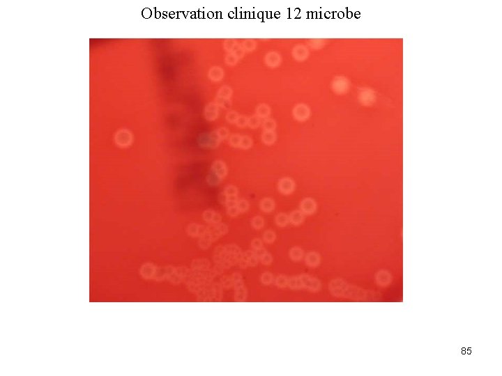 Observation clinique 12 microbe 85 
