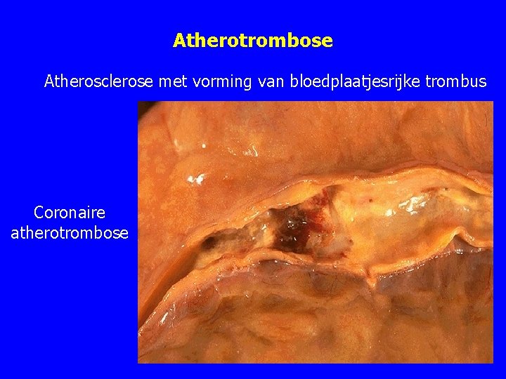 Atherotrombose Atherosclerose met vorming van bloedplaatjesrijke trombus Coronaire atherotrombose Atherotrombose Atherosclerose met vorming van bloedplaatjesrijke trombus Coronaire atherotrombose