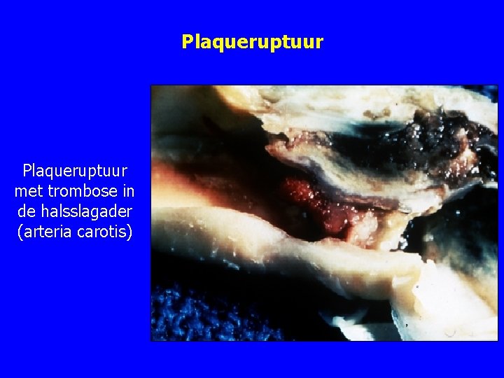 Plaqueruptuur met trombose in de halsslagader (arteria carotis) Plaqueruptuur met trombose in de halsslagader (arteria carotis)