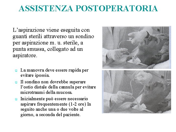 ASSISTENZA POSTOPERATORIA L’aspirazione viene eseguita con guanti sterili attraverso un sondino per aspirazione m.