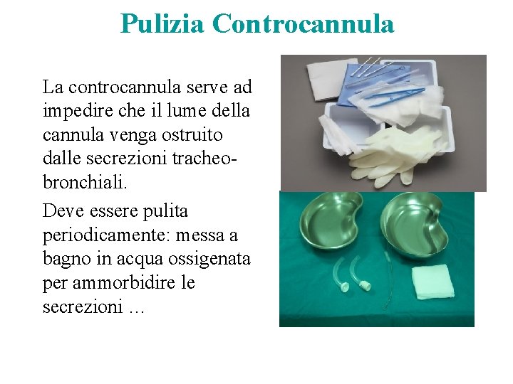 Pulizia Controcannula La controcannula serve ad impedire che il lume della cannula venga ostruito Pulizia Controcannula La controcannula serve ad impedire che il lume della cannula venga ostruito