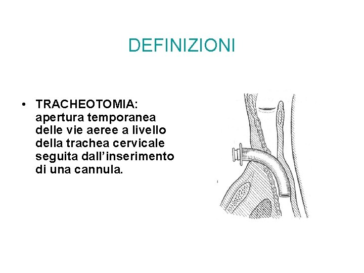 DEFINIZIONI • TRACHEOTOMIA: apertura temporanea delle vie aeree a livello della trachea cervicale seguita