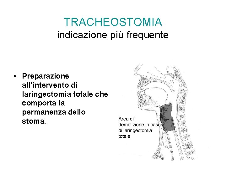 TRACHEOSTOMIA indicazione più frequente • Preparazione all’intervento di laringectomia totale che comporta la permanenza