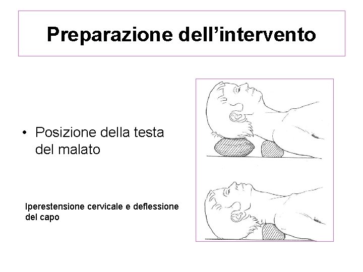 Preparazione dell’intervento • Posizione della testa del malato Iperestensione cervicale e deflessione del capo