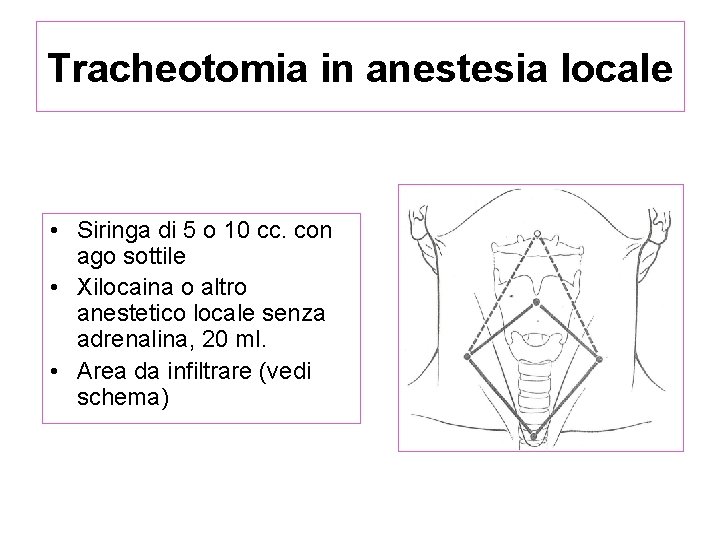 Tracheotomia in anestesia locale • Siringa di 5 o 10 cc. con ago sottile