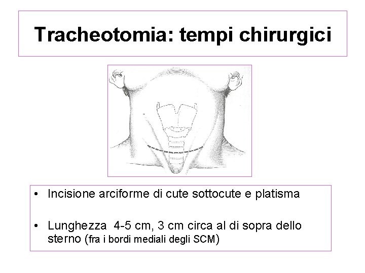 Tracheotomia: tempi chirurgici • Incisione arciforme di cute sottocute e platisma • Lunghezza 4
