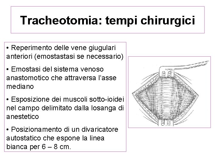 Tracheotomia: tempi chirurgici • Reperimento delle vene giugulari anteriori (emostastasi se necessario) • Emostasi Tracheotomia: tempi chirurgici • Reperimento delle vene giugulari anteriori (emostastasi se necessario) • Emostasi