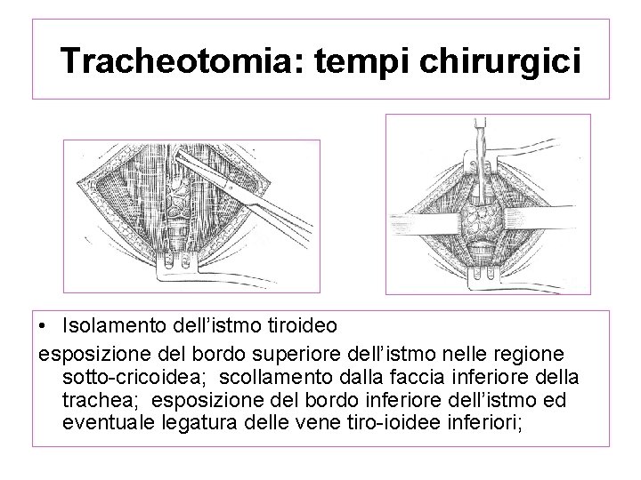 Tracheotomia: tempi chirurgici • Isolamento dell’istmo tiroideo esposizione del bordo superiore dell’istmo nelle regione Tracheotomia: tempi chirurgici • Isolamento dell’istmo tiroideo esposizione del bordo superiore dell’istmo nelle regione