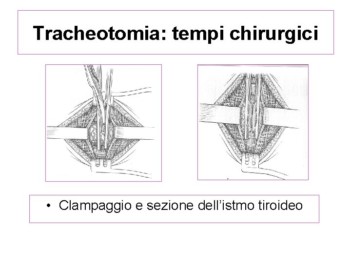 Tracheotomia: tempi chirurgici • Clampaggio e sezione dell’istmo tiroideo 
