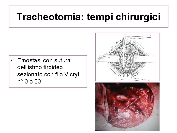 Tracheotomia: tempi chirurgici • Emostasi con sutura dell’istmo tiroideo sezionato con filo Vicryl n°