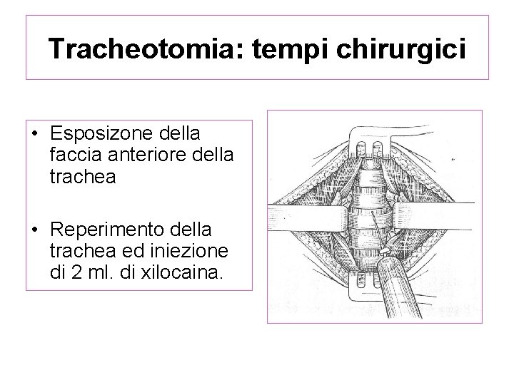 Tracheotomia: tempi chirurgici • Esposizone della faccia anteriore della trachea • Reperimento della trachea