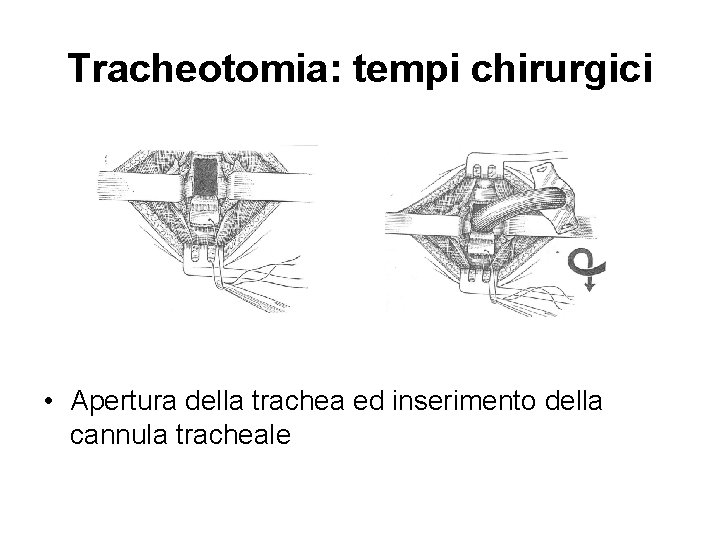 Tracheotomia: tempi chirurgici • Apertura della trachea ed inserimento della cannula tracheale 