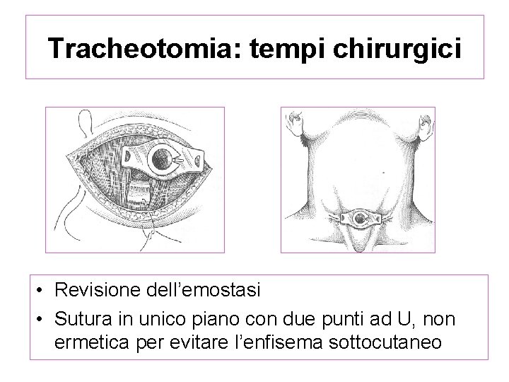 Tracheotomia: tempi chirurgici • Revisione dell’emostasi • Sutura in unico piano con due punti