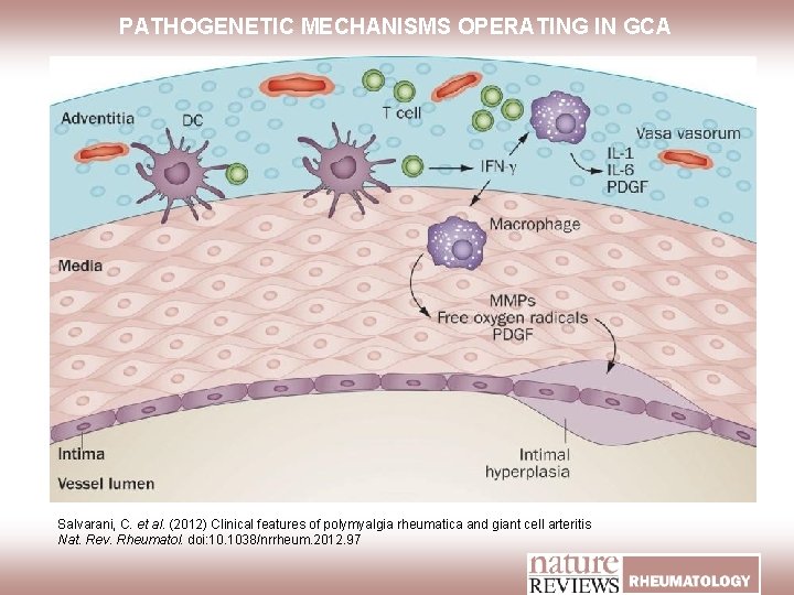 PATHOGENETIC MECHANISMS OPERATING IN GCA Salvarani, C. et al. (2012) Clinical features of polymyalgia