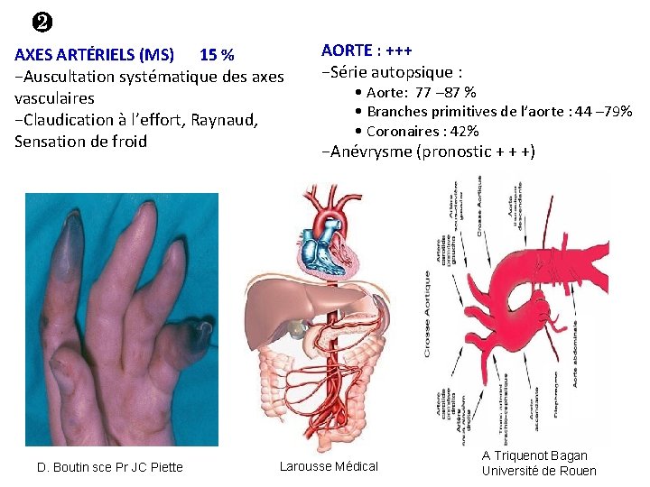 ❷ AXES ARTÉRIELS (MS) 15 % −Auscultation systématique des axes vasculaires −Claudication à l’effort,