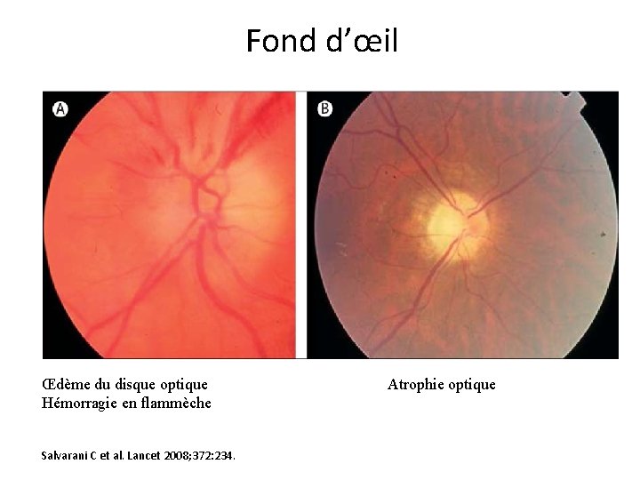 Fond d’œil Œdème du disque optique Hémorragie en flammèche Salvarani C et al. Lancet