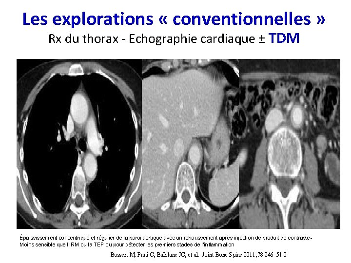 Les explorations « conventionnelles » Rx du thorax - Echographie cardiaque ± TDM Épaississement