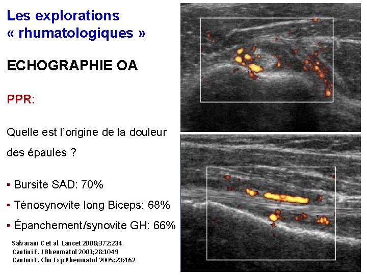 Les explorations « rhumatologiques » ECHOGRAPHIE OA PPR: Quelle est l’origine de la douleur