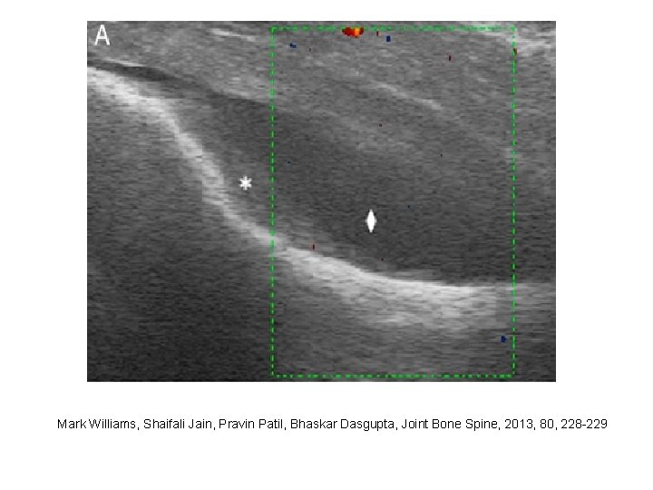 Mark Williams, Shaifali Jain, Pravin Patil, Bhaskar Dasgupta, Joint Bone Spine, 2013, 80, 228