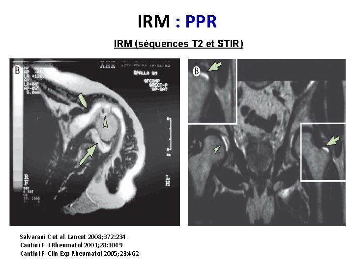 IRM : PPR IRM (séquences T 2 et STIR) Salvarani C et al. Lancet