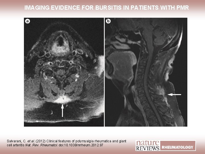 IMAGING EVIDENCE FOR BURSITIS IN PATIENTS WITH PMR Salvarani, C. et al. (2012) Clinical