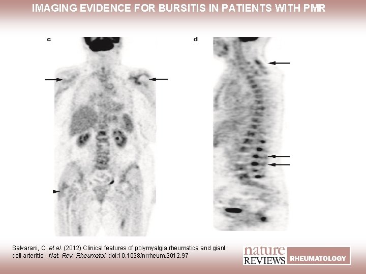 IMAGING EVIDENCE FOR BURSITIS IN PATIENTS WITH PMR Salvarani, C. et al. (2012) Clinical