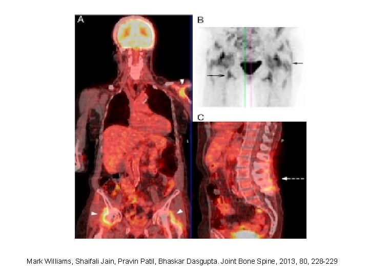 Mark Williams, Shaifali Jain, Pravin Patil, Bhaskar Dasgupta. Joint Bone Spine, 2013, 80, 228