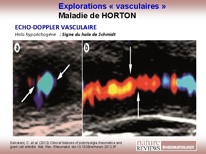 Explorations « vasculaires » Maladie de HORTON ECHO-DOPPLER VASCULAIRE Halo hypoéchogène : Signe du