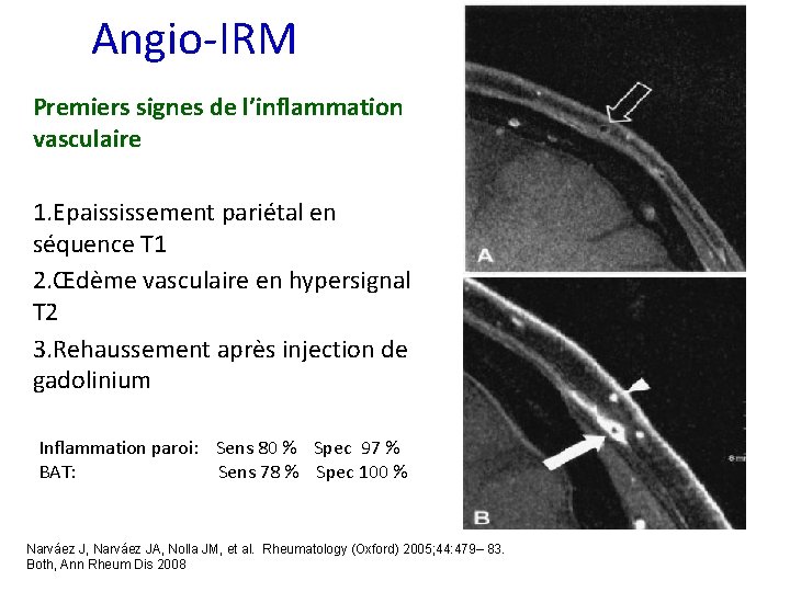 Angio-IRM Premiers signes de l’inflammation vasculaire 1. Epaississement pariétal en séquence T 1 2.