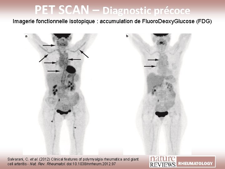 PET SCAN – Diagnostic précoce Imagerie fonctionnelle isotopique : accumulation de Fluoro. Deoxy. Glucose