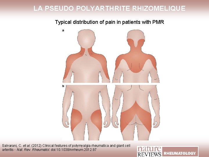 LA PSEUDO POLYARTHRITE RHIZOMELIQUE Typical distribution of pain in patients with PMR Salvarani, C.