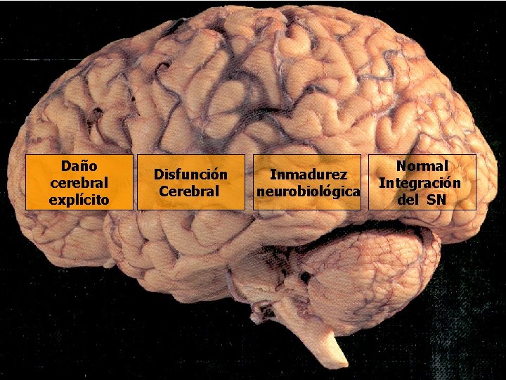 Daño cerebral explícito Disfunción Cerebral Inmadurez neurobiológica Normal Integración del SN Daño cerebral explícito Disfunción Cerebral Inmadurez neurobiológica Normal Integración del SN