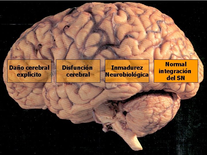 Daño cerebral explícito Disfunción cerebral Inmadurez Neurobiológica Normal integración del SN Daño cerebral explícito Disfunción cerebral Inmadurez Neurobiológica Normal integración del SN