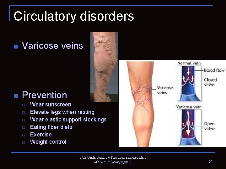 Circulatory disorders n Varicose veins n Prevention q q q Wear sunscreen Elevate legs