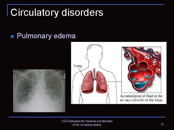Circulatory disorders n Pulmonary edema 2. 02 Understand the functions and disorders of the
