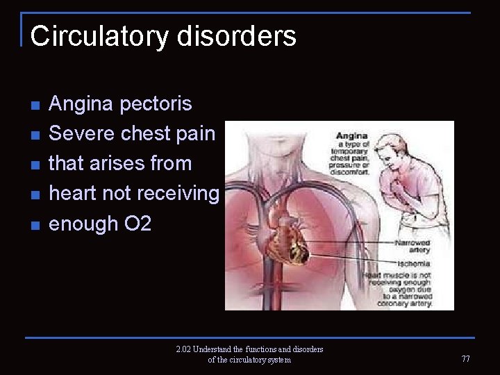 Circulatory disorders n n n Angina pectoris Severe chest pain that arises from heart