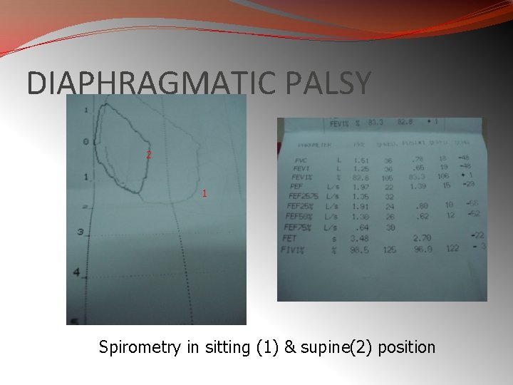 DIAPHRAGMATIC PALSY 2 1 Spirometry in sitting (1) & supine(2) position 