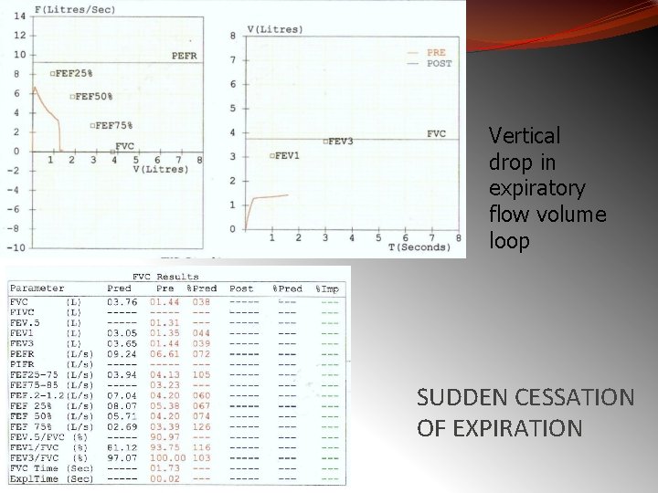 Vertical drop in expiratory flow volume loop SUDDEN CESSATION OF EXPIRATION 