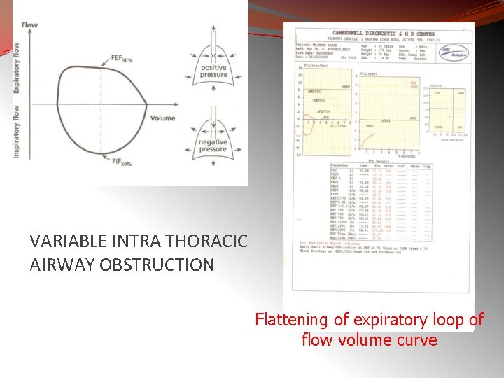 VARIABLE INTRA THORACIC AIRWAY OBSTRUCTION Flattening of expiratory loop of flow volume curve 
