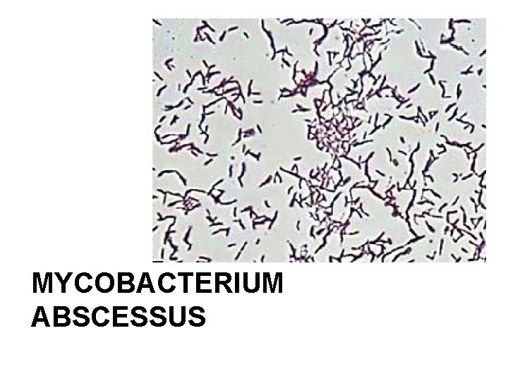 MYCOBACTERIUM ABSCESSUS 