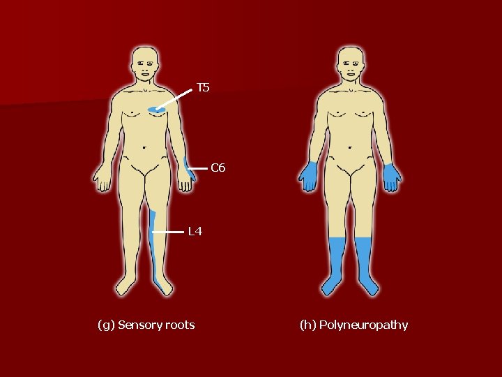 T 5 C 6 L 4 (g) Sensory roots (h) Polyneuropathy 