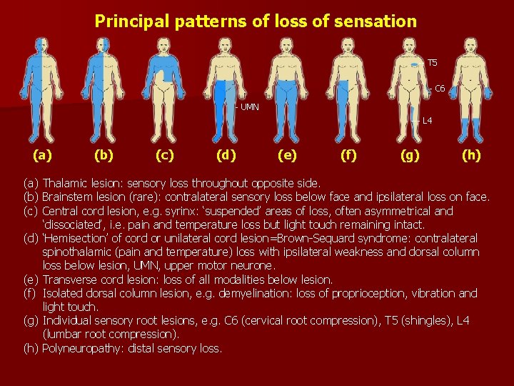 Principal patterns of loss of sensation -- T 5 - C 6 - UMN
