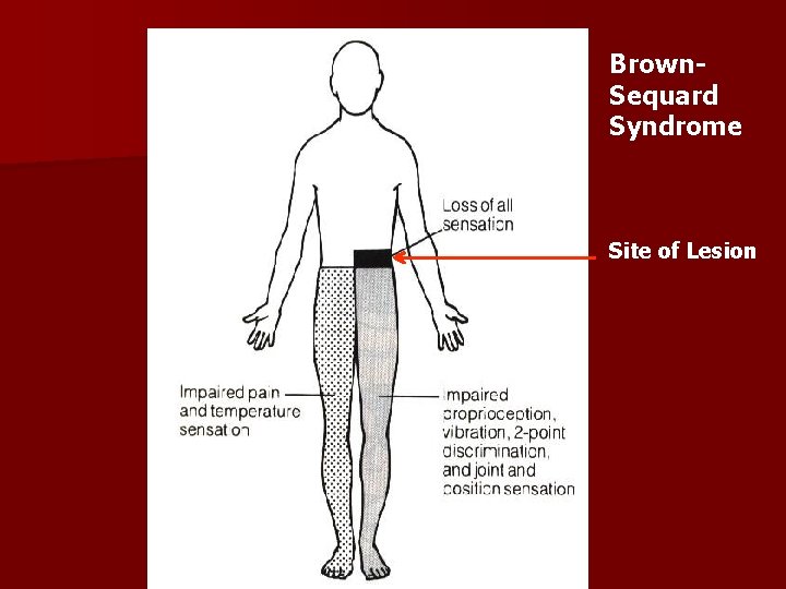 Brown. Sequard Syndrome Site of Lesion 