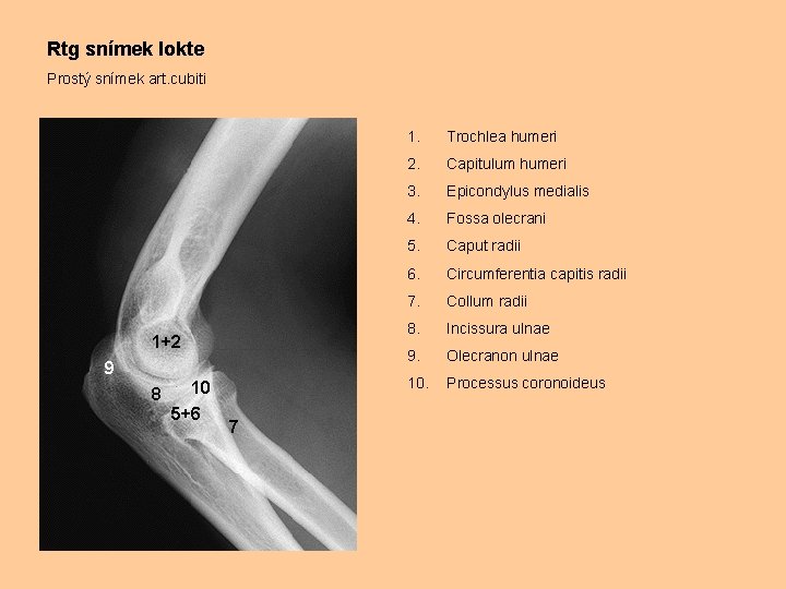 Rtg snímek lokte Prostý snímek art. cubiti 1+2 9 8 10 5+6 7 1.