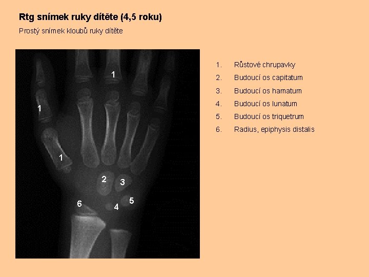 Rtg snímek ruky dítěte (4, 5 roku) Prostý snímek kloubů ruky dítěte 1 1