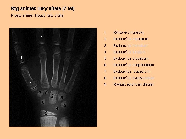 Rtg snímek ruky dítete (7 let) Prostý snímek kloubů ruky dítěte 1 1 1