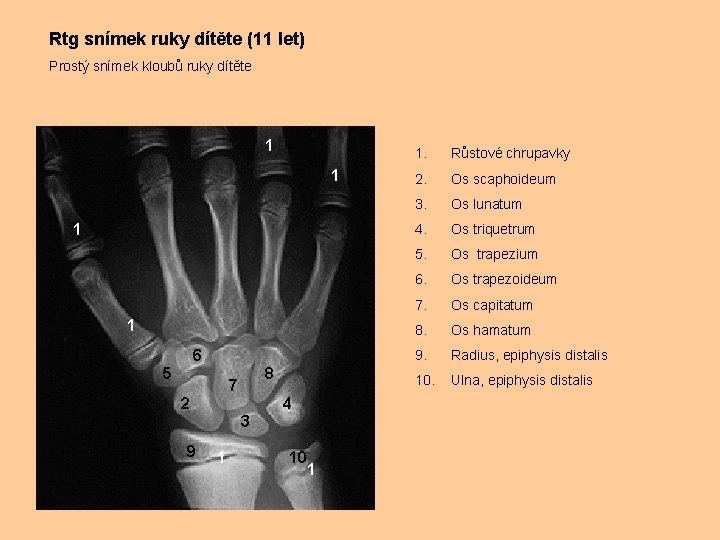 Rtg snímek ruky dítěte (11 let) Prostý snímek kloubů ruky dítěte 1 1 6
